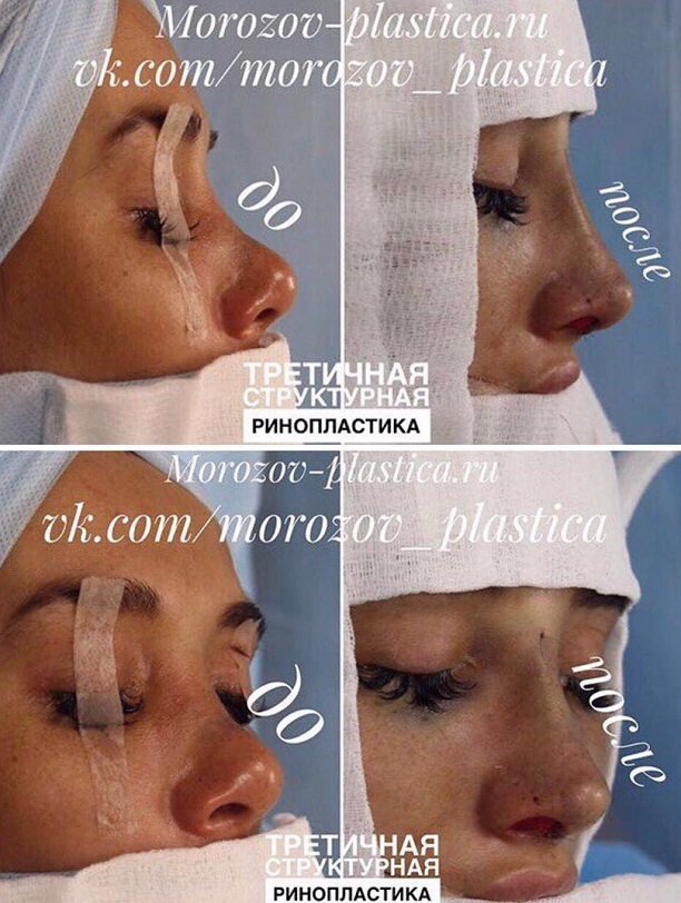 Марина Мексика шокировала последствиями второй операции на нос