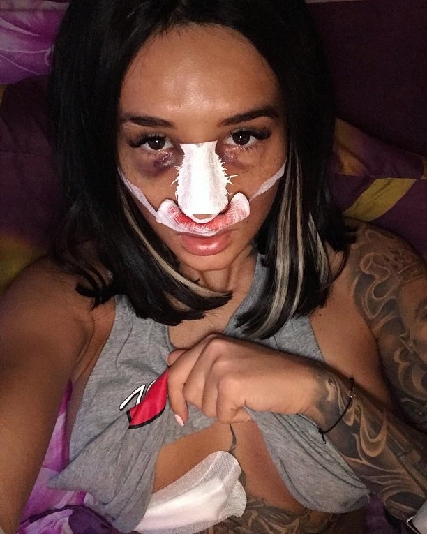 Марина Мексика шокировала последствиями второй операции на нос