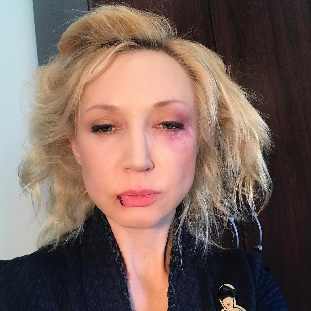 Кристина Орбакайте опубликовала селфи со следами побоев на лице
