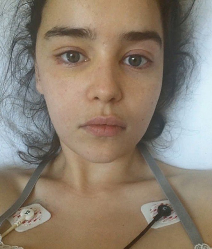 Эмилия Кларк ужаснула рассказом об операциях и инсульте и показала фото из больницы