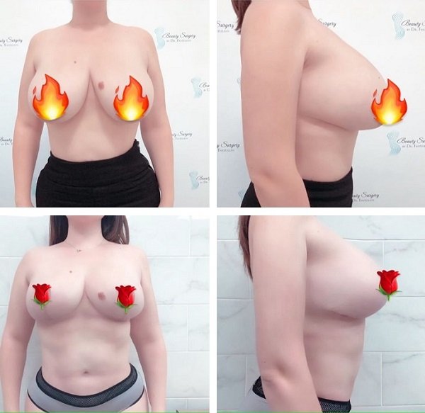 Модель Plus Size Юлия Рыбакова показала поклонникам свою новую грудь