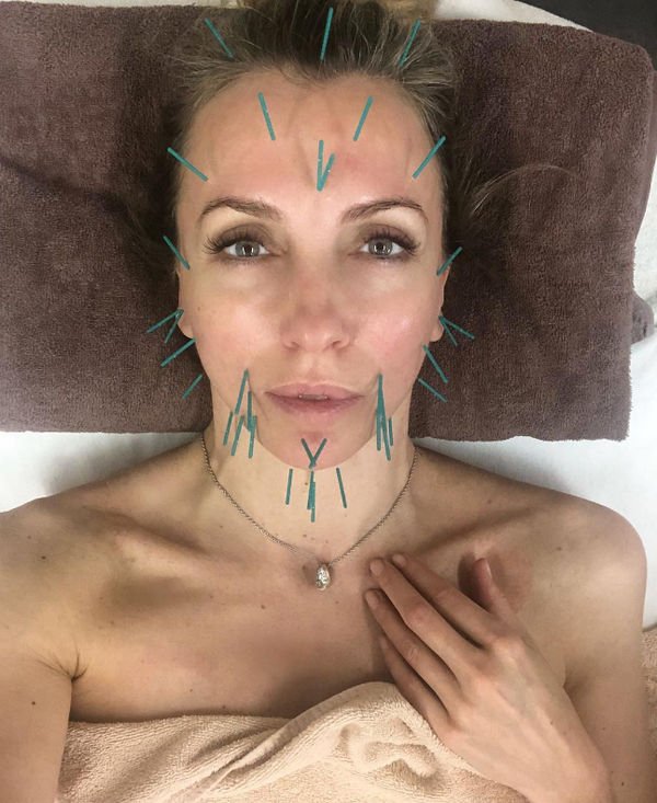 Светлана Бондарчук опубликовала жуткий снимок с иголками на лице