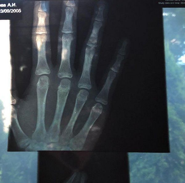 Дочь Анастасии Волочковой сломала руку во время занятий спортом