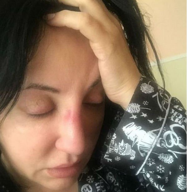 Фатима Хадуева не может разговаривать после очередной операции