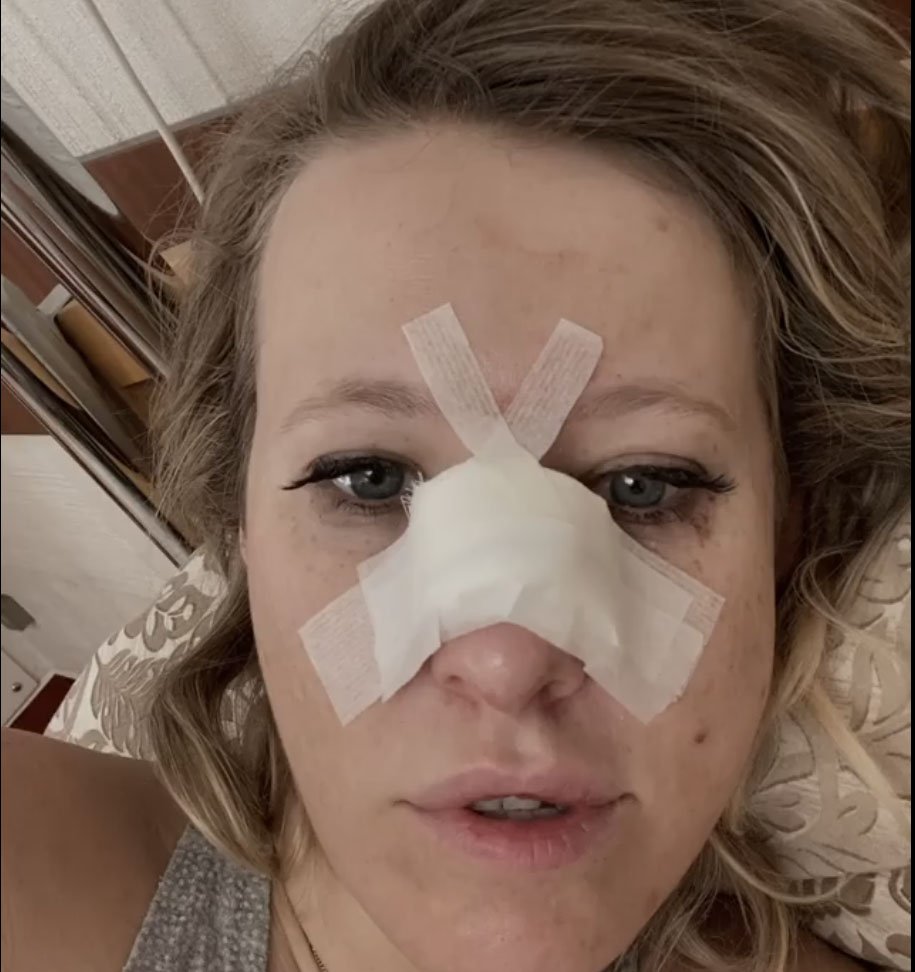 Сотрясение и перелом носа: Ксения Собчак попала в больницу и перенесла операцию
