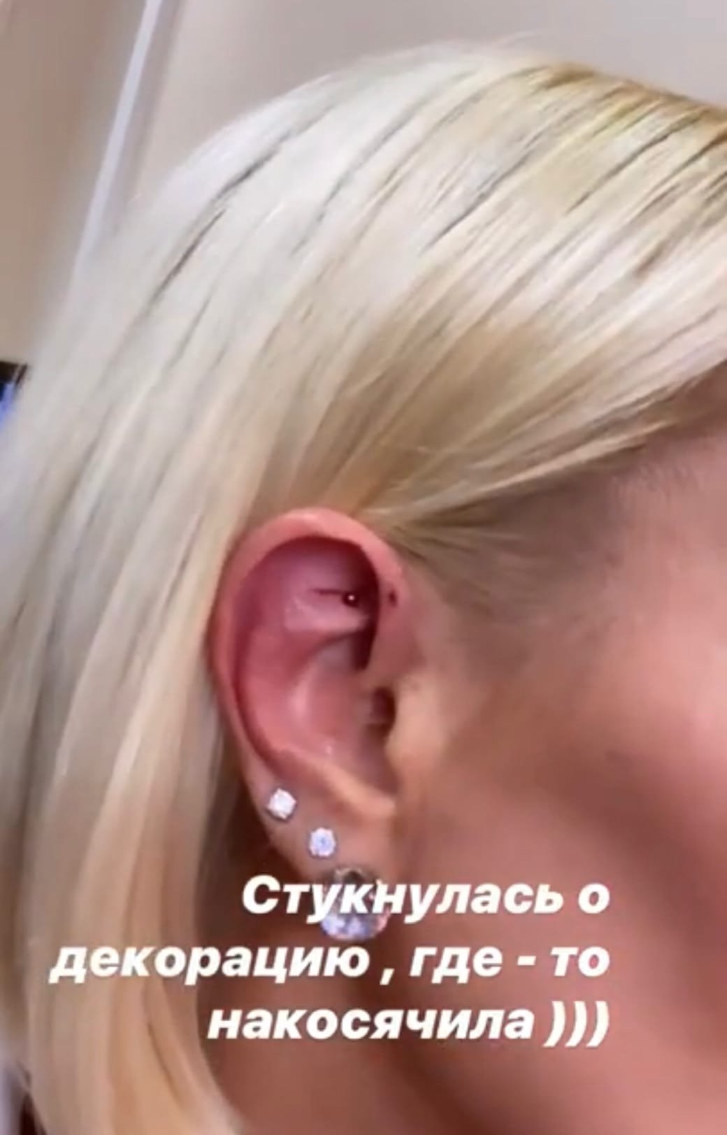 Лера Кудрявцева получила травму во время съемок