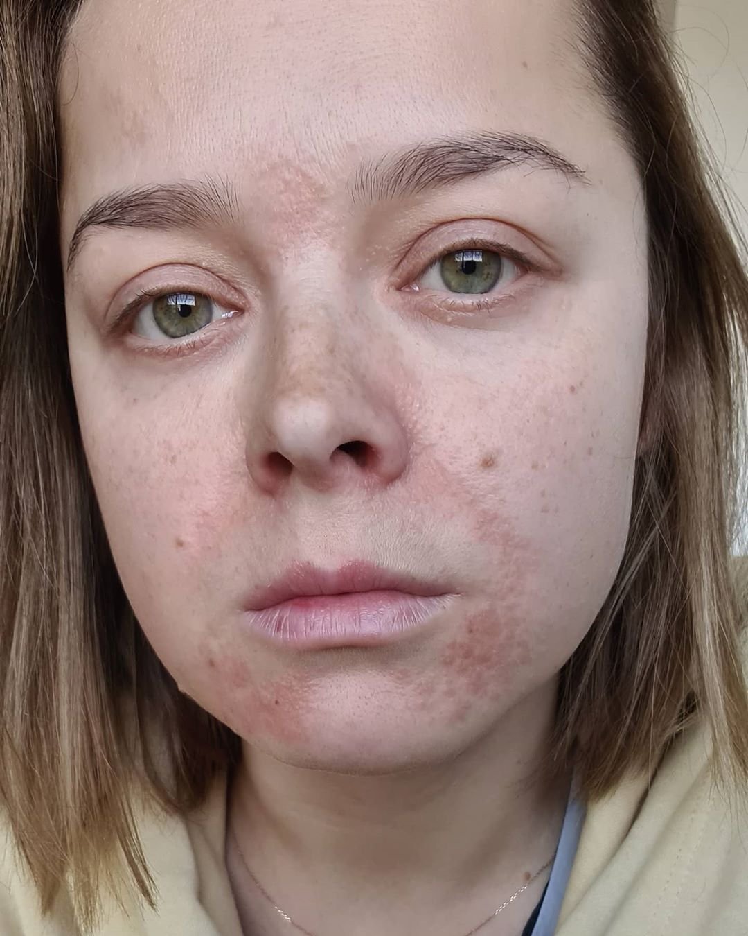 Наталья Медведева показала лицо, обезображенное хронической болезнью