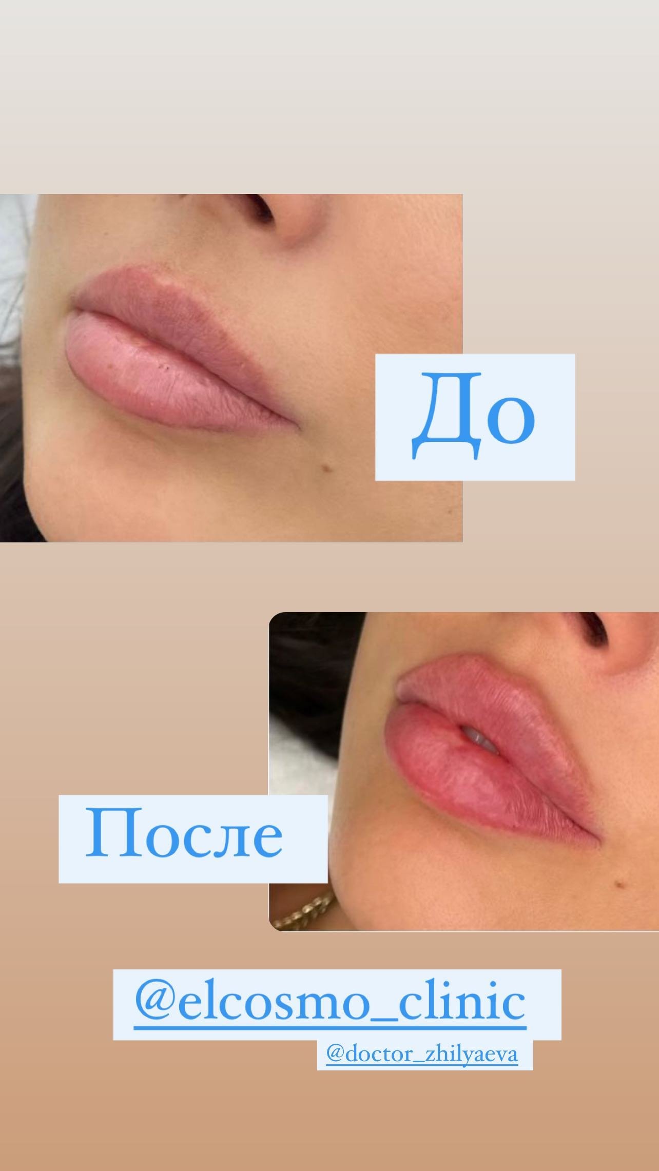 Оксана Самойлова показала результат переделанных губ