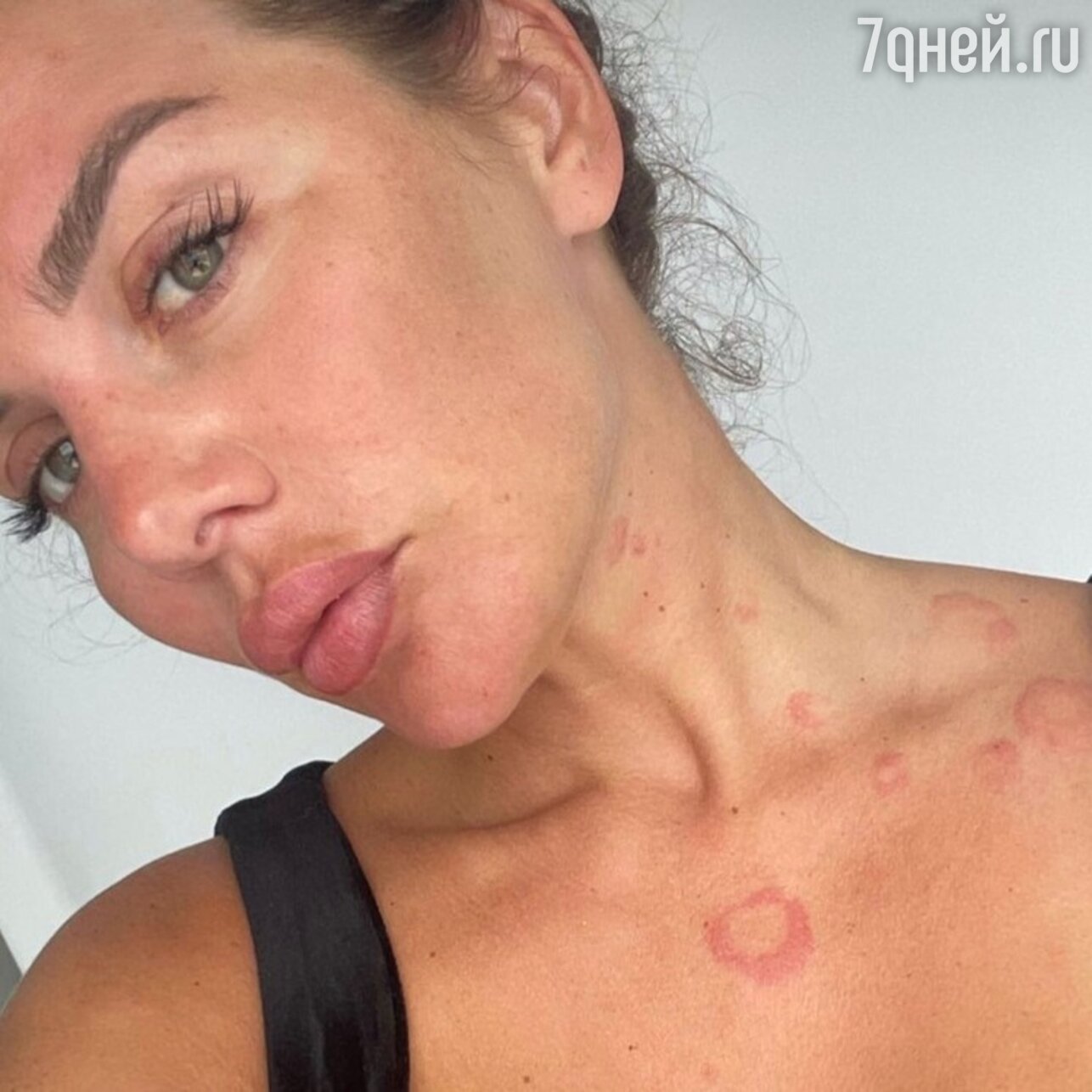 "Я - леопард": Анна Седокова показала пятна на теле от болезни
