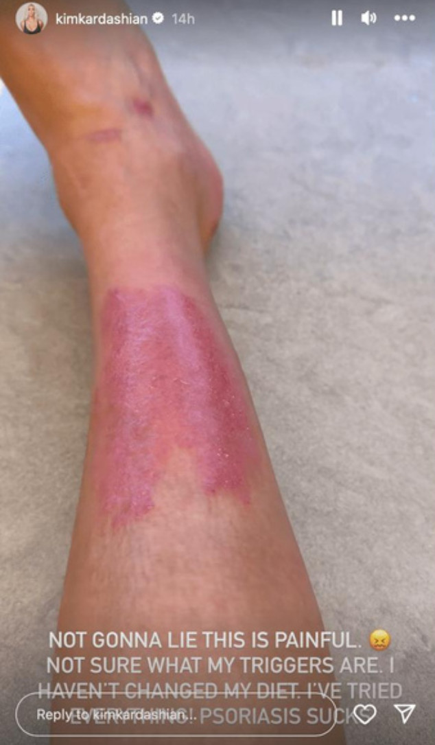 Ким Кардашьян опубликовала очень личное фото псориаза на ноге