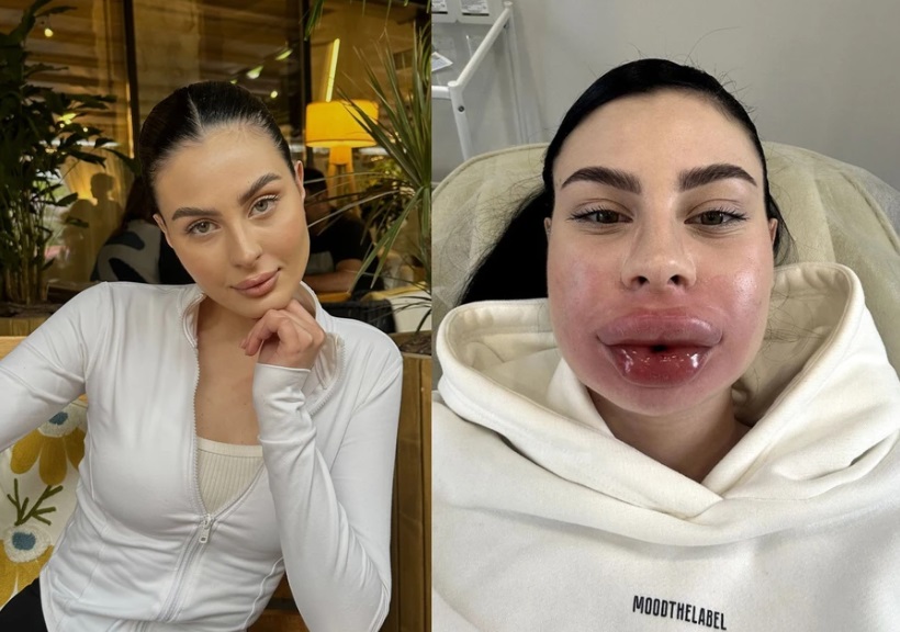У 23-летней блогерши Софьи Большаковой раздуло губы после удаления геля